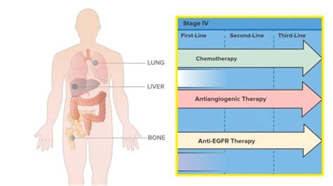 Metastatic Colorectal Cancer Prognosis - CancerWalls