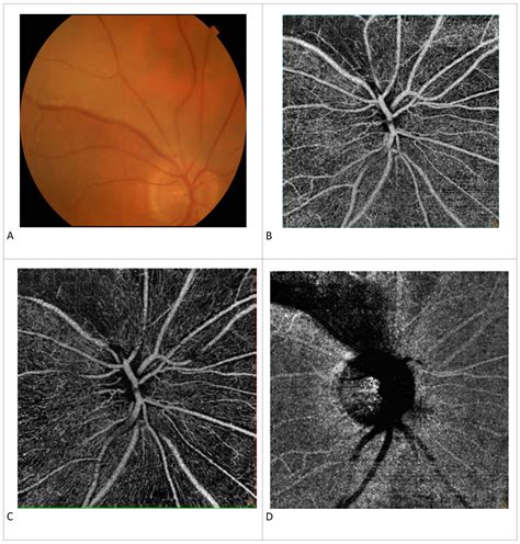 Branch Retinal Artery Occlusion