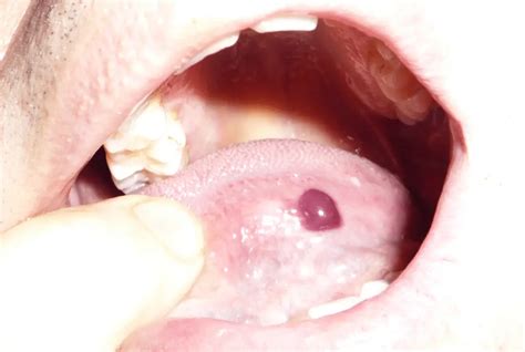 Blood Blisters In Mouth- Causes, Symptoms, Remedies, And Treatment | Treat, Cure Fast