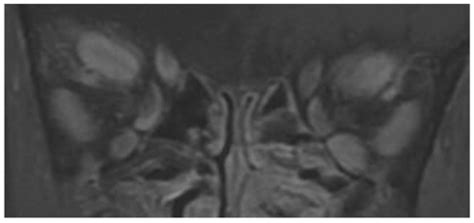 Thyroid-Associated Orbitopathy: An Evidence-Based Approach to Diagnosis and Management | Ento Key