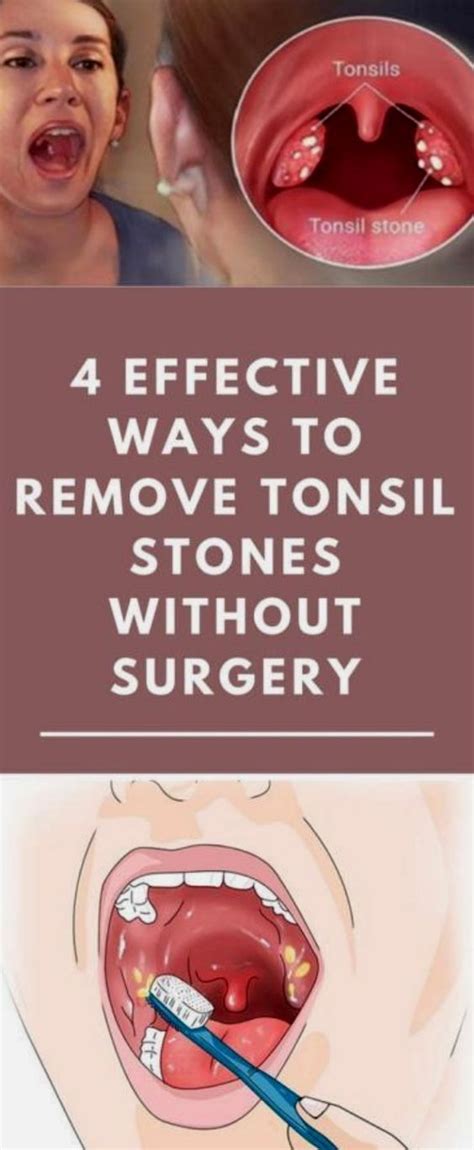 How to get rid of tonsil stones | Healthy Bright