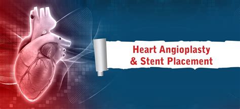 Angioplasty Stent Placement Procedure for Heart | Amandeep Hospital