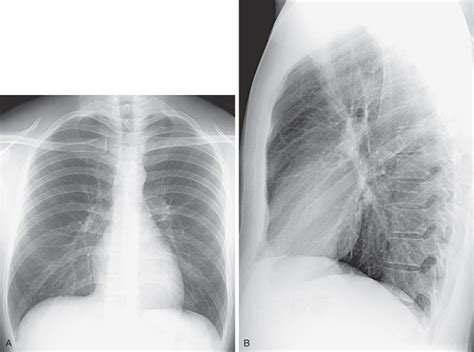 Normal Chest X Ray Images