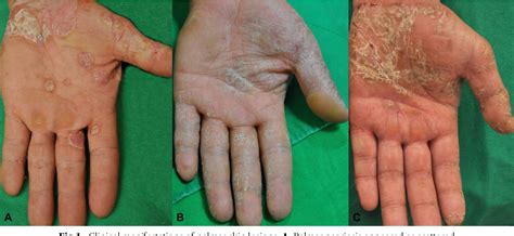 Figure 1 from The histopathological differentiation between palmar psoriasis and hand eczema: A ...