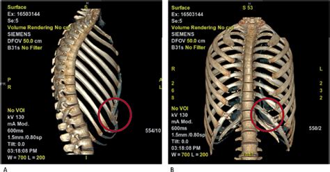 Preoperative 3D reconstruction CT imaging with circled costal margin... | Download Scientific ...