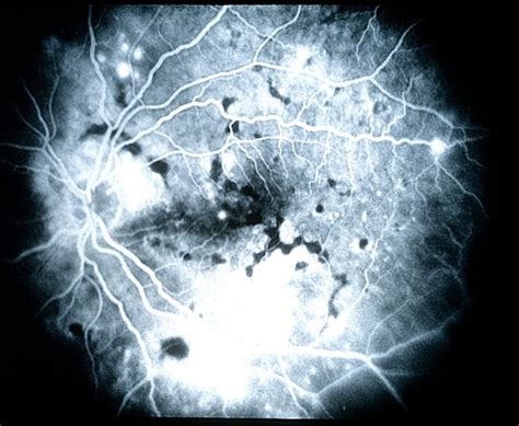 Central Serous Chorioretinopathy 7 - Retina Image Bank