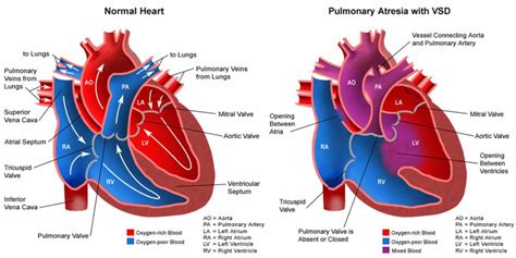 Pulmonary Atresia - Causes, Types, Symptoms, Diagnosis & Treatment