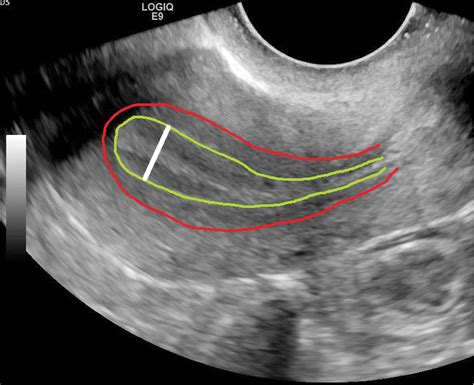 Endometrial/junctional zone thickening | Radiology Key