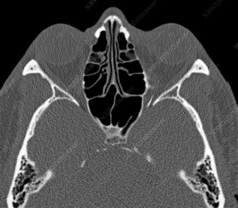 Normal sinuses, CT scan - Stock Image - C029/4631 - Science Photo Library