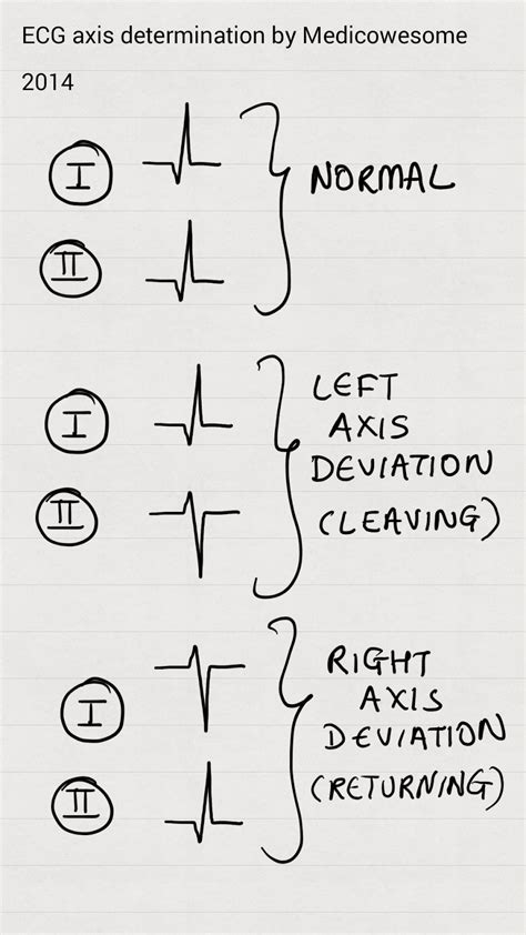 Ecg Axis Deviation Chart : EKG Anatomy/Axis (from Life in the Fast Lane) | MedTx - Right axis ...