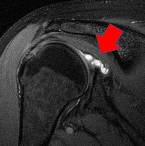 Disorders of the Glenoid Labrum – Orthopaedia: Sports Medicine