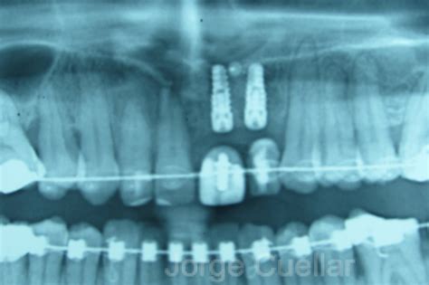 Guided Bone Regeneration, Dental Implants- Gingival Graft and In Ceram ...