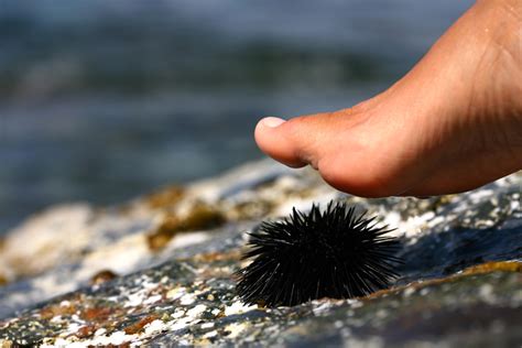 How to treat a sea urchin sting