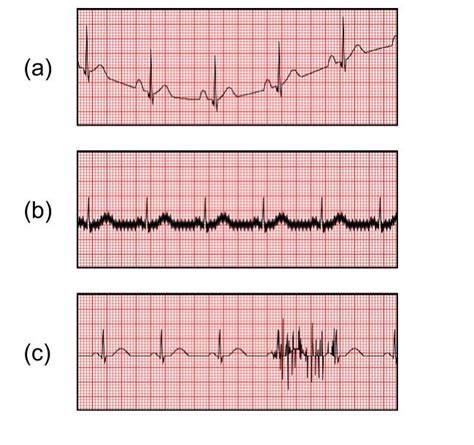 Guide To Understanding ECG Artifact ACLS Medical Training, 53% OFF