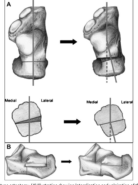 Figure 2 from What is the role and limit of calcaneal osteotomy in the ...