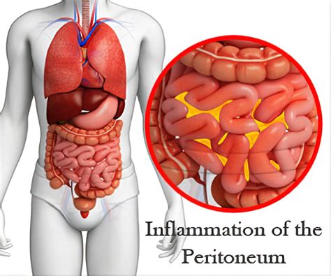 Peritonitis - Peritonitis Symptoms Causes Treatment Bulksupplements Com