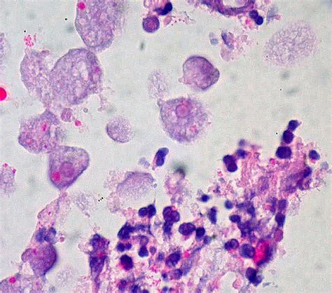 [Figure, Amebic colitis Courtesy of Pathology outlines (http://www.pathologyoutlines.com ...