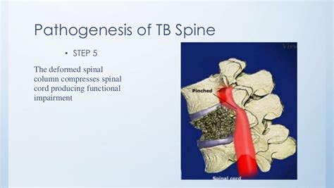 Tuberculosis of spine