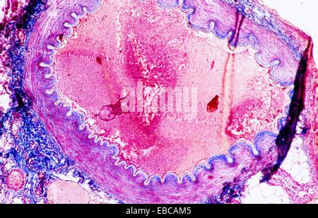 ATHEROMA, HISTOLOGY Stock Photo - Alamy