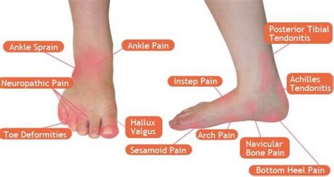 Most Common Foot Problems - TopFootwears