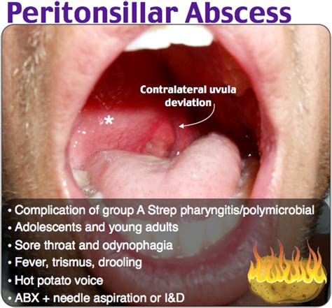 Peritonsillar Abscess Rosh Review | Throat medicine, Emergency medicine, Reviews