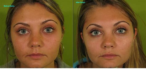 Brow Lift Botox Before And After Photos : Before and After Galleries ...