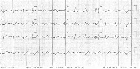 Right Bundle Branch Block (RBBB) • LITFL • ECG Library Diagnosis