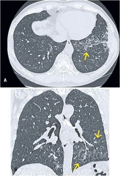 What Does Mass On The Lungs Mean