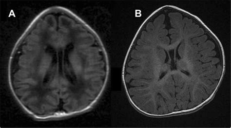 Patient 5 MRI scan showing a cavum septum pellucidum (a). Patient 6 MRI ...