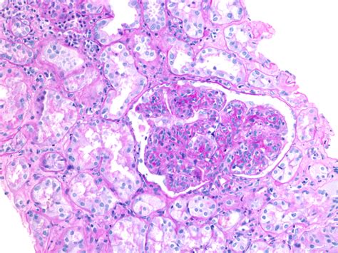 Membranoproliferative glomerulonephritis - American Society of ...