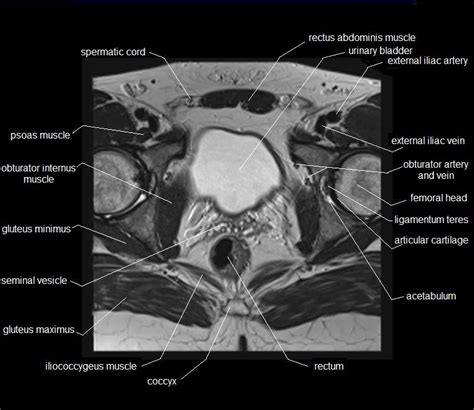 Muscles Of Pelvis Ct Anatomy