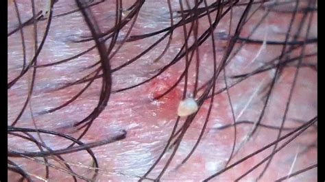 Popping Inflamed Hair Follicle On Scalp - YouTube