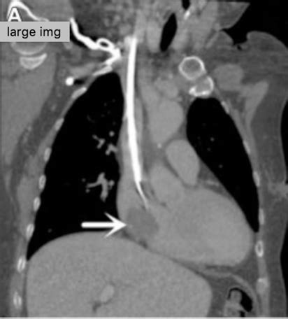 Hemodialysis Catheter Complications (And What To Do About Them) - Renal Fellow Network