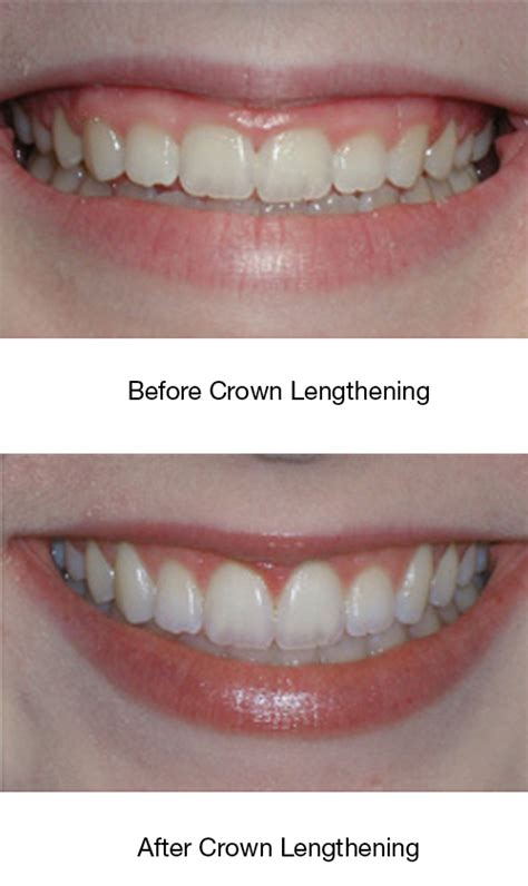 Crown Lengthening – Altschuler