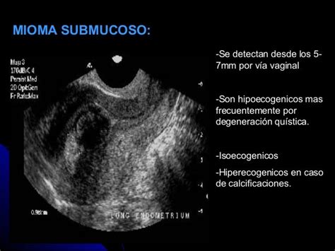 (2) ecografia ginecologica presentacion 29.06.16