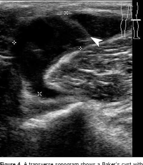 Figure 3 from Sonography of Baker’s Cyst (Popliteal Cyst): the Typical and Atypical Features ...