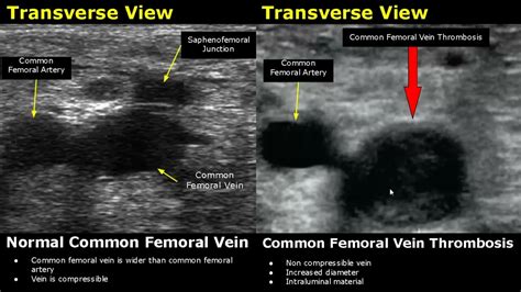 Femoral Artery Ultrasound