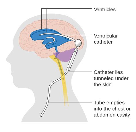 CSF Shunt Placement | Intracranial pressure, Central nervous system, Cancer care