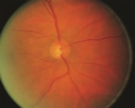 Optic disc pit - American Academy of Ophthalmology