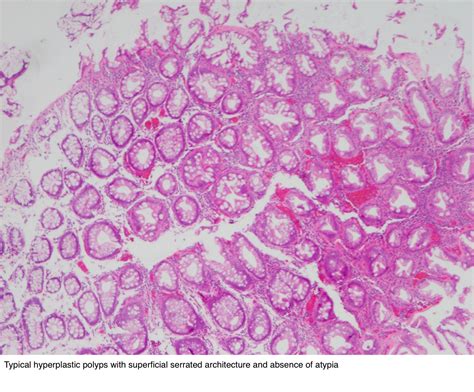 Colon Polyp Histology