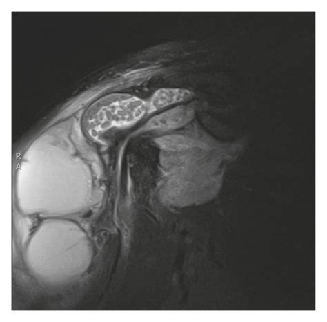 Subdeltoid Bursitis Mri