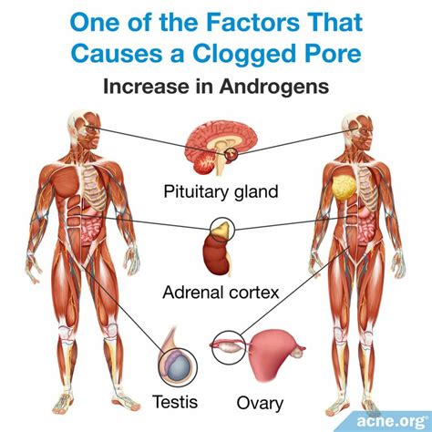 What Is Acne - An In-depth Look - Acne.org