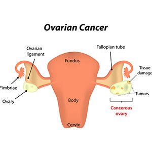 Ovarian Cancer Diagnosis and Treatment - Women's Cancer and Surgical ...