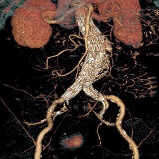 CT angiography 12 months after EVAR procedure showing favourable... | Download Scientific Diagram