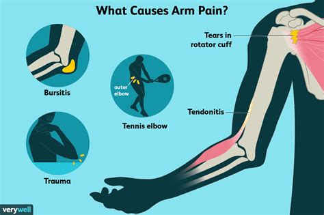 Arm Pain: Causes, Treatment, and When to See a Doctor