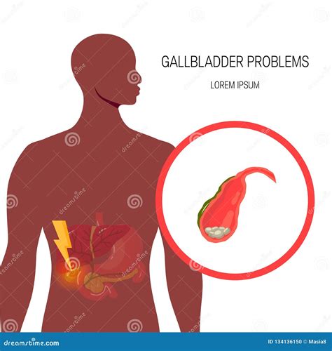 Medical Illustration of the Bile Duct, Vector Stock Vector ...