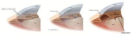 Glaucoma Information Angle closure glaucoma - Glaucoma Information