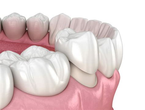 Dental Crown Materials - Westerville Dental Associates