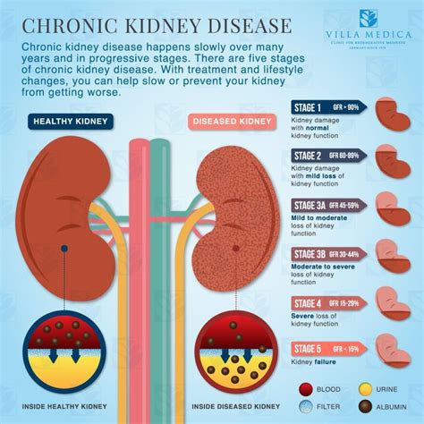 Villa Medica - Chronic Kidney Disease Explained - Infographic | Chronic kidney disease diet ...