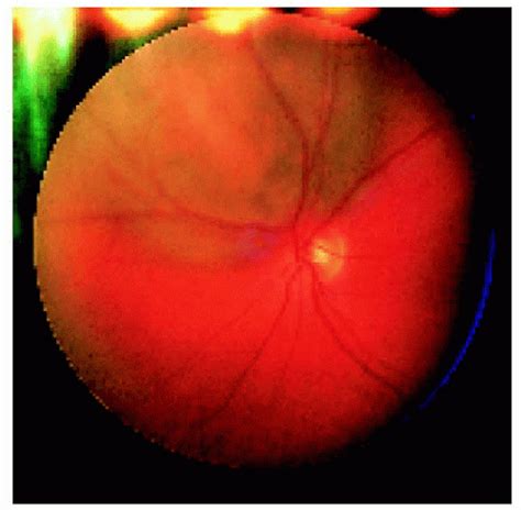 Choroidal Nevus | Ento Key